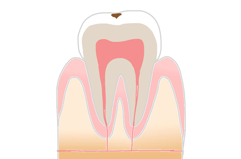 C1(エナメル質のむし歯)