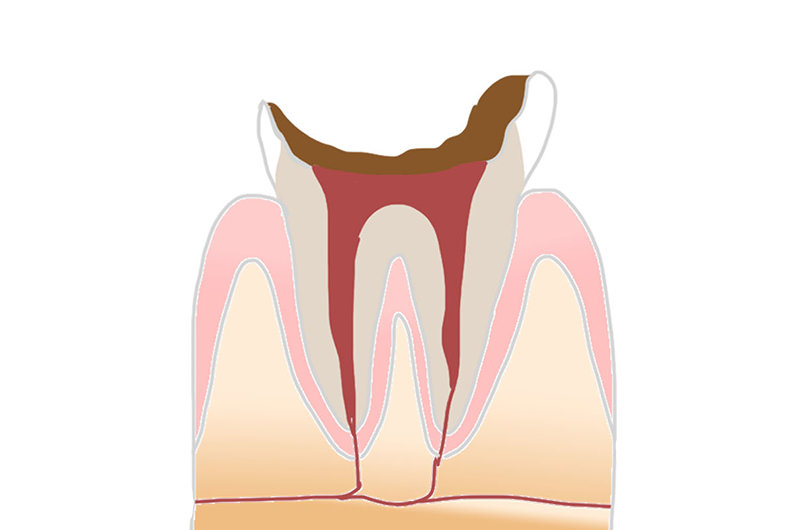 C4(歯の根のむし歯)