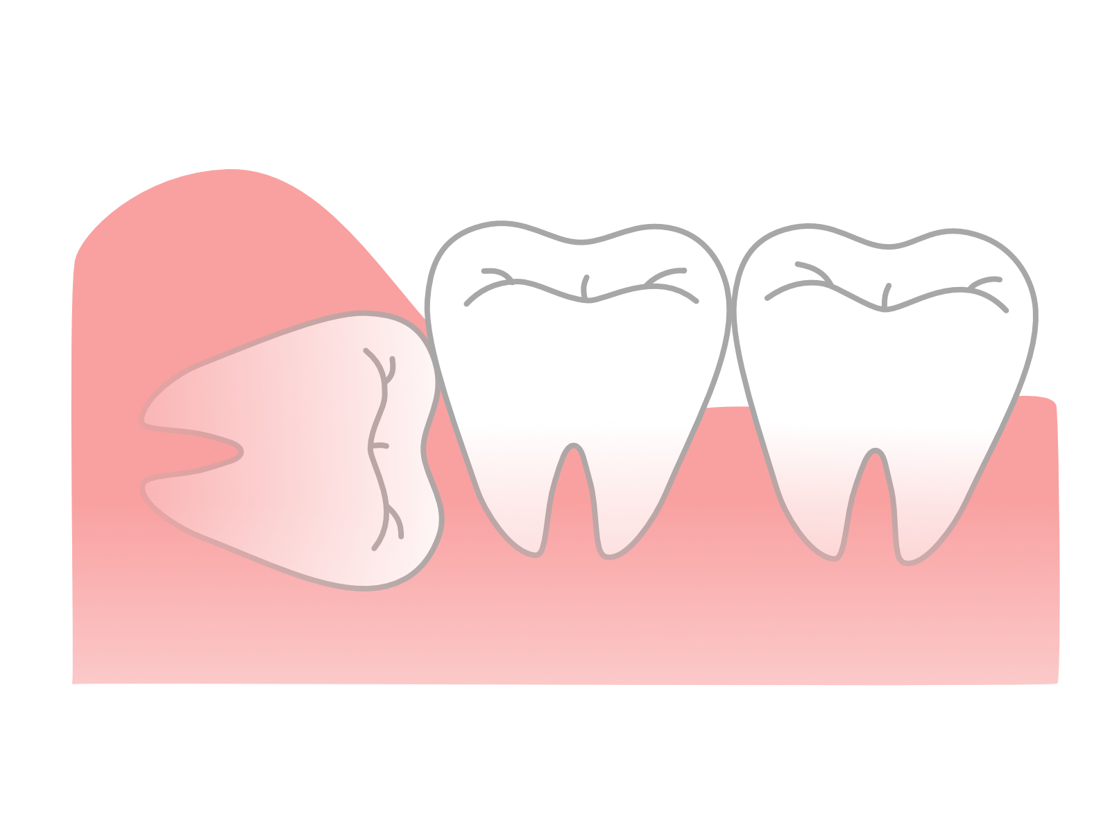 親知らずの抜歯は口腔外科に任せよう！リスクやメリットを紹介します